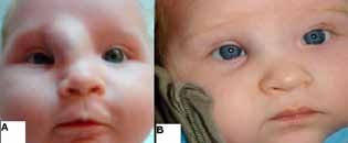 Initial Experiences with Propranolol Treatment of Infantile Hemangiomas:  Report of Three Cases