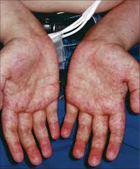 نتیجه جستجوی لغت [graft] در گوگل