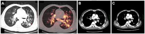 This article will explain what lung cancer is, how to recognize. Cutaneous Metastasis As The First Presentation Of Non Small Cell Lung Ott