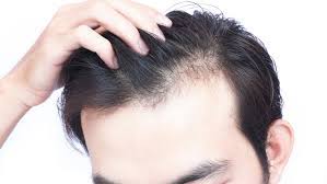 When stress causes thinning hair, people usually notice their hair returning to its normal volume once the stressful situation begins to pass. Going Bald Too Young Ohio State Medical Center