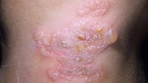 Do You Have An Std You Re Not The Only One Everyday Health