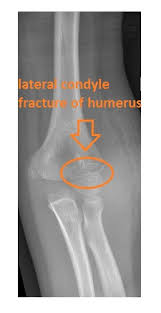 Image result for Lateral Condyle Fracture