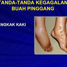 Oleh itu, kerosakan buah pinggang merupakan masalah kesihatan yang menakutkan penghidapnya. Tanda Tanda Buah Pinggang Anda Rosak