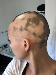 Alopecia areata is hair loss, usually reversible, in sharply defined areas, usually involving beard or scalp.1 it is listed in the mirena product information as an uncommon adverse effect occurring in ≥0.1 per cent to <1 per cent, based on information collected during controlled clinical trial comparing. Mum Left With Patchy Bald Head When Hair Fell Out After Using Contraceptive Coil Mirror Online