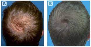 A patients blood is withdrawn and put into a machine called a centrifuge, which spins the blood tube to separate out the red blood cells from the plasma. Acell Prp Hair Regrowth Therapy Ozone Park Howard Beach New York