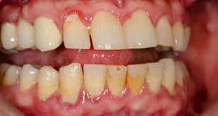 Improper oral health care gingivitis is very common in children and adults and occurs when plaque is allowed to accumulate on the teeth. Gingivitis Periodontal Disease Triphala And Oral Health