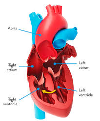Image result for Ventricular Septal Defect