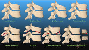 Image result for Fracture Types