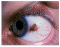 Image result for conjunctival melanoma