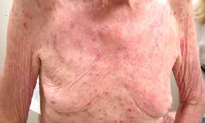 Image result for scabies norvegica