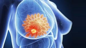 See how breast cancer metastasis affects the body, possible. Chemotherapy Free Treatment For Breast Cancer Spread To The Lymph Node