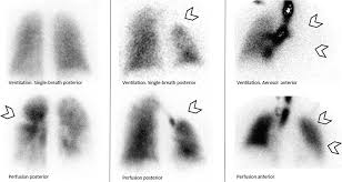 Image result for Ventilation Perfusion Scan