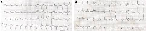 Physiological q waves did you know that in some patients who have significant q waves in lead iii may not have infarct at all? Unmasking Of Pathologic Q Waves By Left Bundle Branch Pacing Springerlink