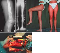 Image result for Osteosarcoma