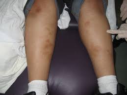 Image result for erythema nodosum