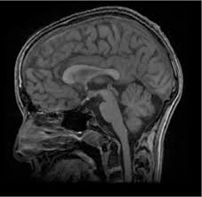 Figure 3 From Pituitary Stalk Interruption Syndrome A Briefing Semantic Scholar