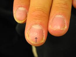 Image result for Pitting nails feet