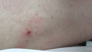 Pull upward with steady, even pressure. How To Remove A Tick Head Stuck In Your Skin Mom Goes Camping