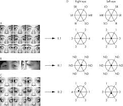 Image result for Extraocular Movement
