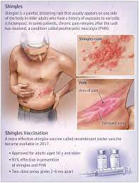 Building material used as siding or roofing 1. Jama Ø¹ÙÙ ØªÙÙØªØ± This Jama Patient Page Describes Shingles The Shingles Vaccine And Who Should Be Vaccinated Against Shingles Https T Co Doa8jysyly Https T Co Gffhgzxfwz