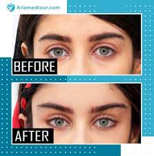 To undergo an eye surgery in a foreign country is a very hard decision. Canthoplasty In Iran Top Eyelid Surgeons Ariamedtour