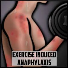 Image result for Exercise-Induced Anaphylaxis