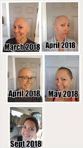 Losing eyebrow hair can be quite distressing. See Real Results After Chemo Treatments Chemo Hair Growing Hair After Chemo Chemo Hair Loss