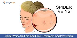 This makes your veins more visible and prominent. Spider Veins On Feet And Face Treatment And Prevention Pristyn Care