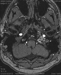It can stem from something as. Tinnitus