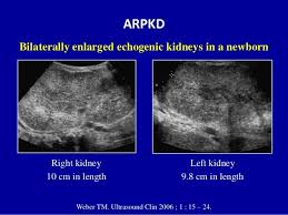 Ultrasound Of The Urinary Tract Renal Cysts Arpkd Autosomal Recessive Polycystic Kidney Disease Polycystic Kidney Disease Echogenic Kidney Renal