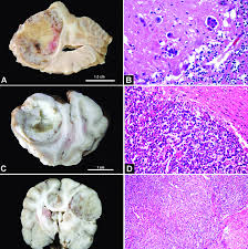 Sadly, for dogs diagnosed with lung cancer the prognosis is poor. Metastatic Lung Carcinoma And Other Metastatic Neoplasms A A Focal Download Scientific Diagram