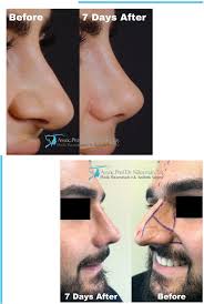 Thick Skin Bulbous Tip Rhinoplasty Assoc Prof Dr Suleyman Tas Rhinoplasty Nose Jobs Nose Contouring Nose Surgery