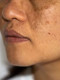 Image result for Melasma calycinum
