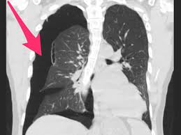 The cdc study sheds some light on the teen vaping uptick. Photos Show Vaping Lung Damage Like Blisters And Lung Collapse