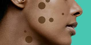 Hyperpigmentation lasts longer in darker skin types because the more melanin that is produced, the deeper it sinks into the skin and the harder it is to get rid of, says lily armed with the information i needed, i developed a routine fit for my skin type through trial and error over the course of two weeks. 9 Dark Spot Treatments That Really Work According To Dermatologists Self