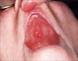 Image result for Physical injury red spots roof of mouth