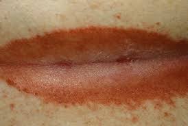 Intertrigo is an inflammatory skin condition in which there is rash between the folds of the skin. Dermhelpcentral Intertrigo