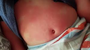 They more commonly had rash and mucocutaneous involvement and less commonly had shock or myocardial. New Global Health Warning About Mis C Rare Inflammatory Syndrome In Children Abc7 San Francisco