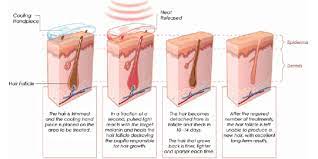 It had been performed experimentally for about twenty years before becoming commercially available in 1995 and 1996. Laser Hair Removal Camarillo Ventura Ca Beyond Aesthetics