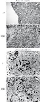 Os tumores carcinoides têm sido chamados de câncer em câmera lenta, porque eles crescem lentamente. Tumores Diagnosticados Microscopicamente Como Um Tumor Carcinoide Download Scientific Diagram