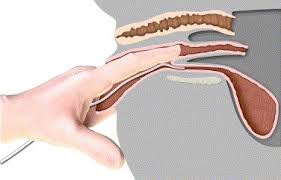 Image result for Urethral Catheterization