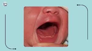 Image result for Neonatal Teeth