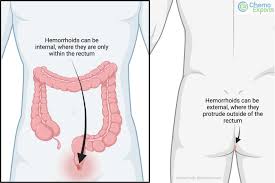 Image result for hemorrhoids