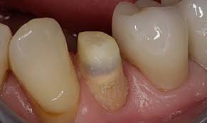 Check spelling or type a new query. How And Why To Use Activa Bioactive Cement For Crown Cementation