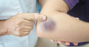 3 reasons to see a doctor if you develop bruises - ClikiSalud.net | Carlos Slim Foundation