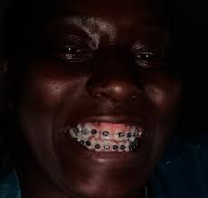 Can I get Invisalign with a missing tooth I'm the back?