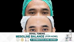 Perawatan untuk Menghilangkan Jerawat