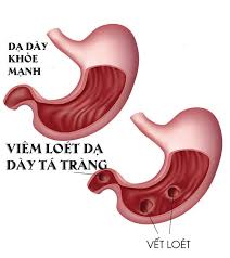 Chuyển giao công nghệ novasol curcumin thế hệ 4.0 mới nhất từ chlb đức. Viem Loet Dáº¡ Day Phong Kham Ä'a Khoa