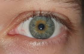 (in martins case blue and brown). Central Heterochromia Or Hazel Heterochromia