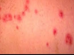 Maybe you would like to learn more about one of these? Bed Bug Bites Pictures Patterns Symptoms And Remedy